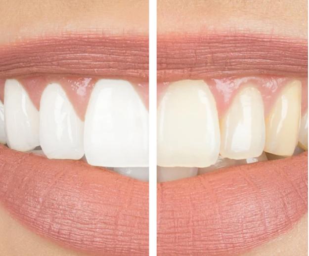 Peroxide-Free Teeth Whitening Products: What They Are And How To Use Them